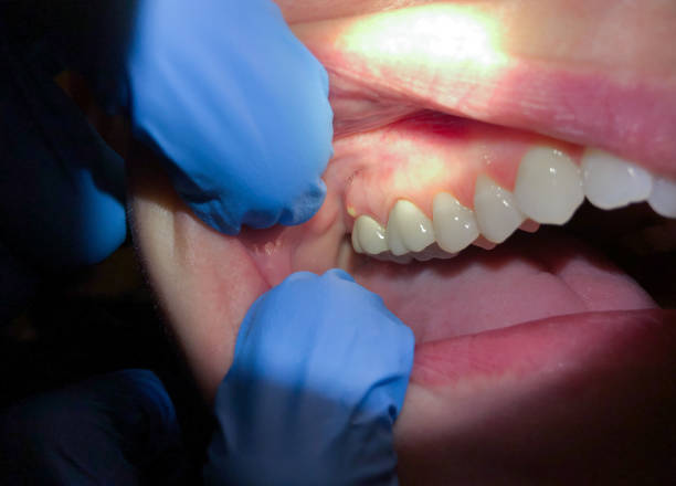 Best Emergency Dental Care for Broken or Chipped Teeth in San Diego Country Estates, CA